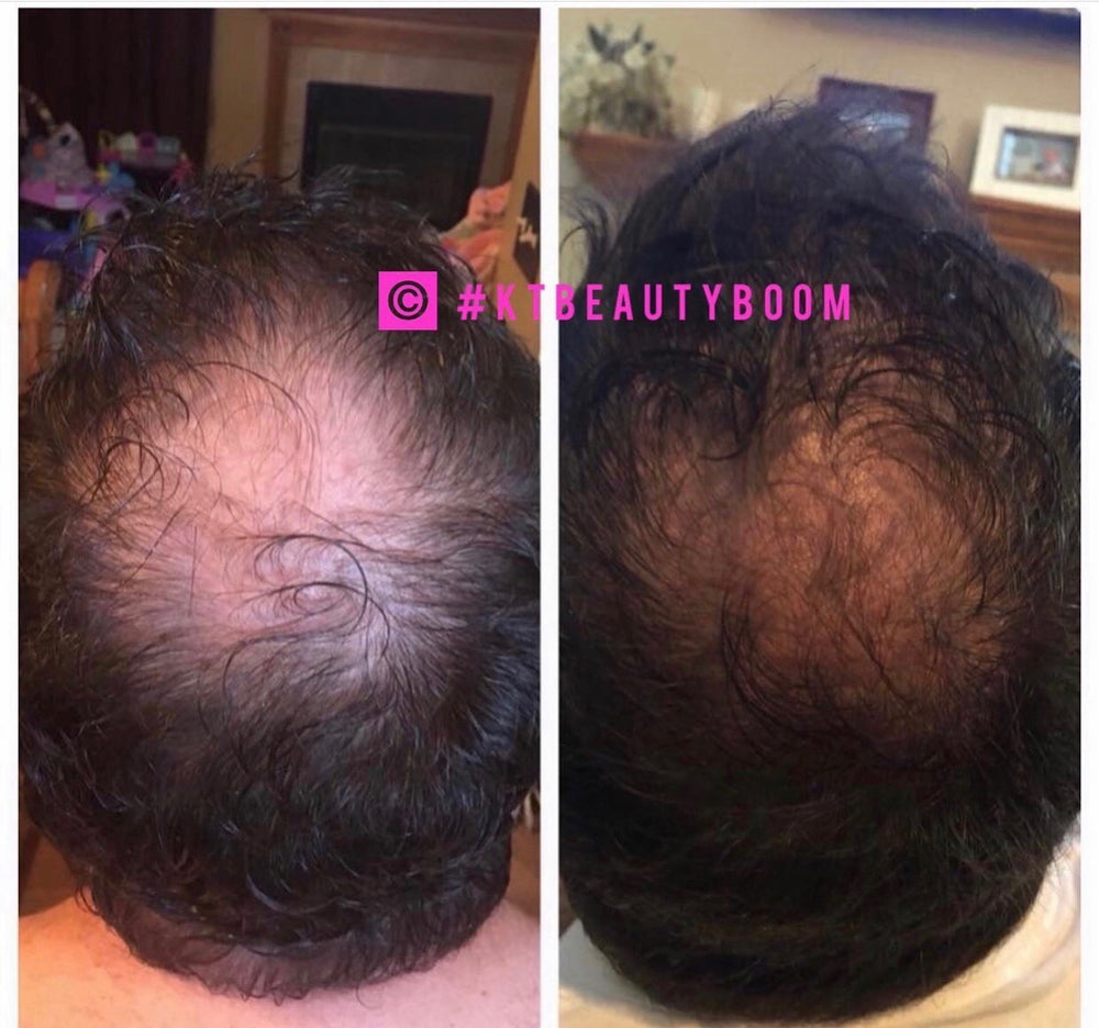 Scalp Consultation - KT BEAUTY BOOM
